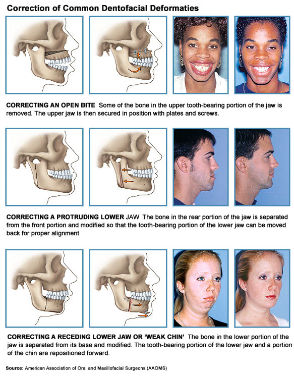 Dentofacial Orthodontic Surgery in Langley, BC