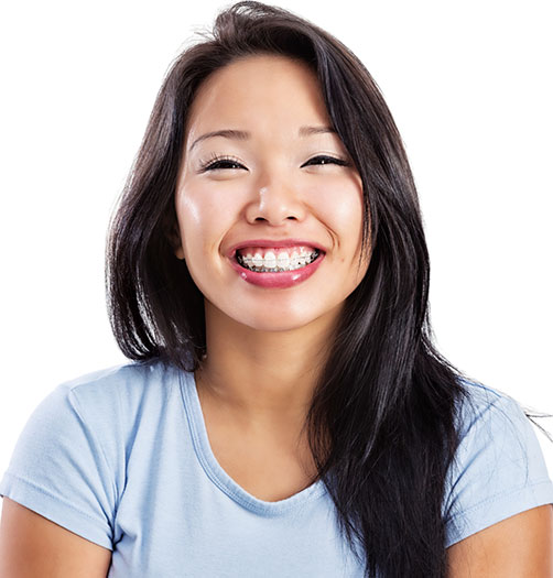 Langley's Translucent Cosmetic Braces at Langley Orthodontics