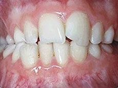 Cross Bite, Langley Orthodontics