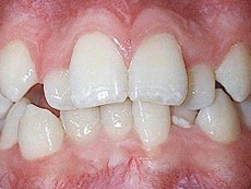 Crowding Teeth, Langley Orthodontics