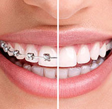 Download Answers to Invisalign Questions, Langley