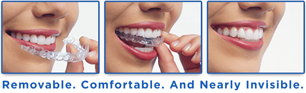 Invisalign Clear Braces, Langley Orthodontics