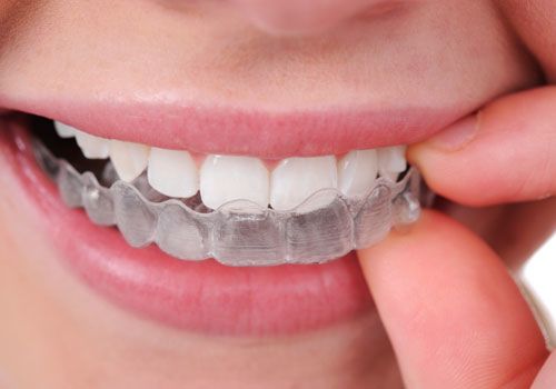 Invisalign Clear Braces, Langley