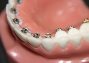 Lingual (Behind the Teeth Braces), Langley