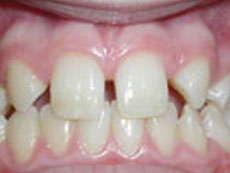 Missing Teeth, Langley Orthodontics