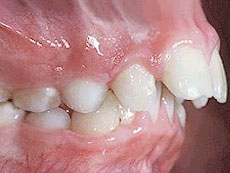 Protruded Teeth, Langley Orthodontics
