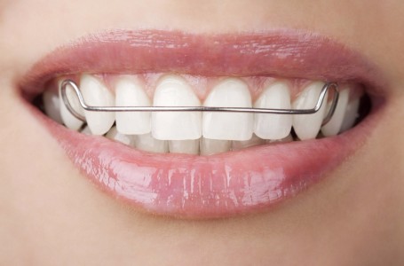 Retainer & Expander Instructions, Langley Orthodontics