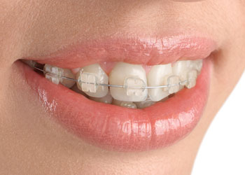 Translucent Cosmetic Braces, Langley, BC